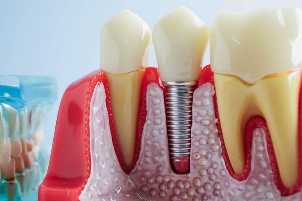 Dental Implants Horizon City